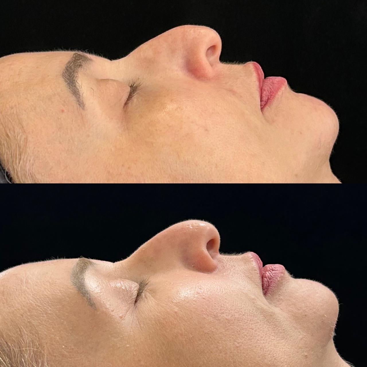 Antes e depois — Perfil & contorno facial