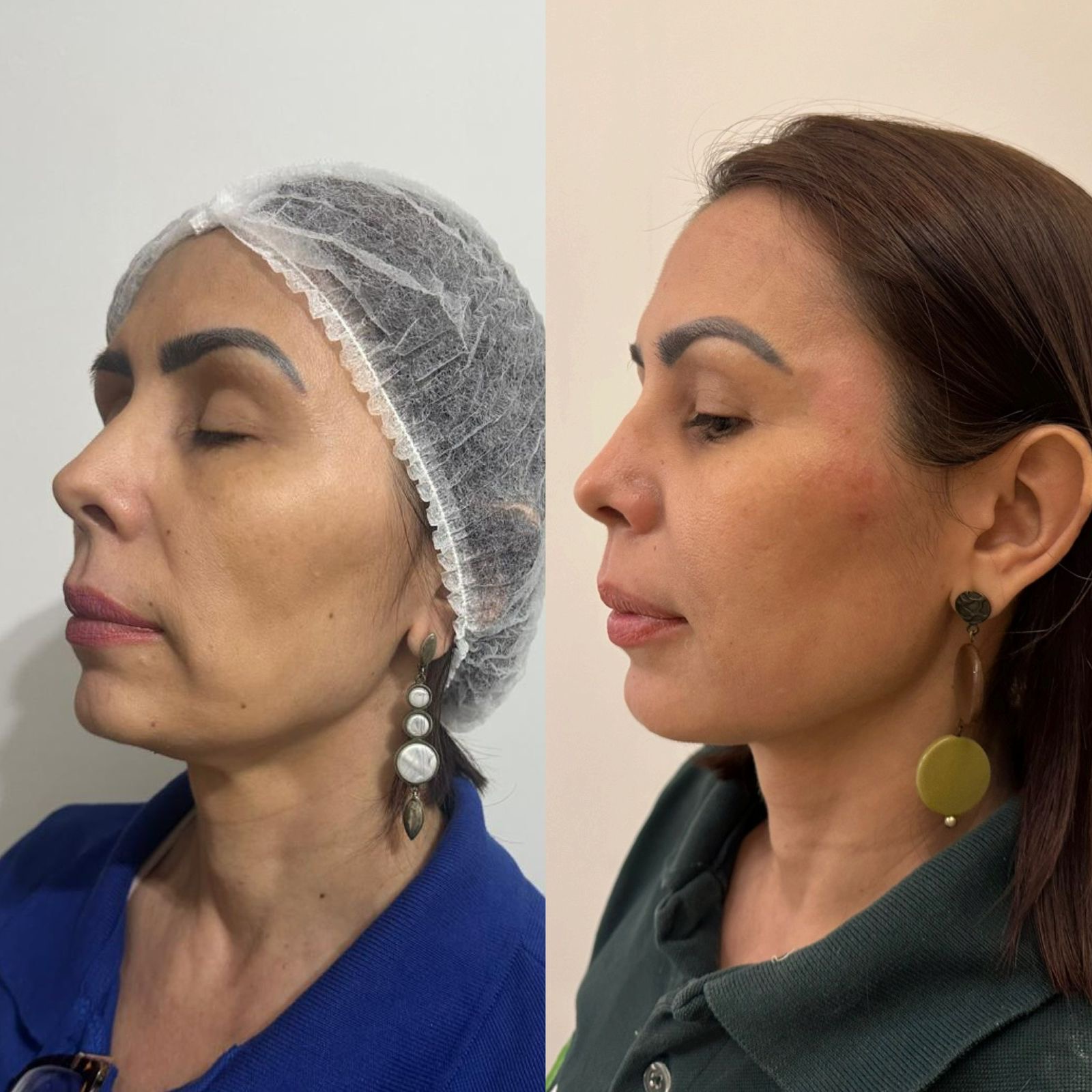 Antes e depois — Lifting facial sem cirurgia