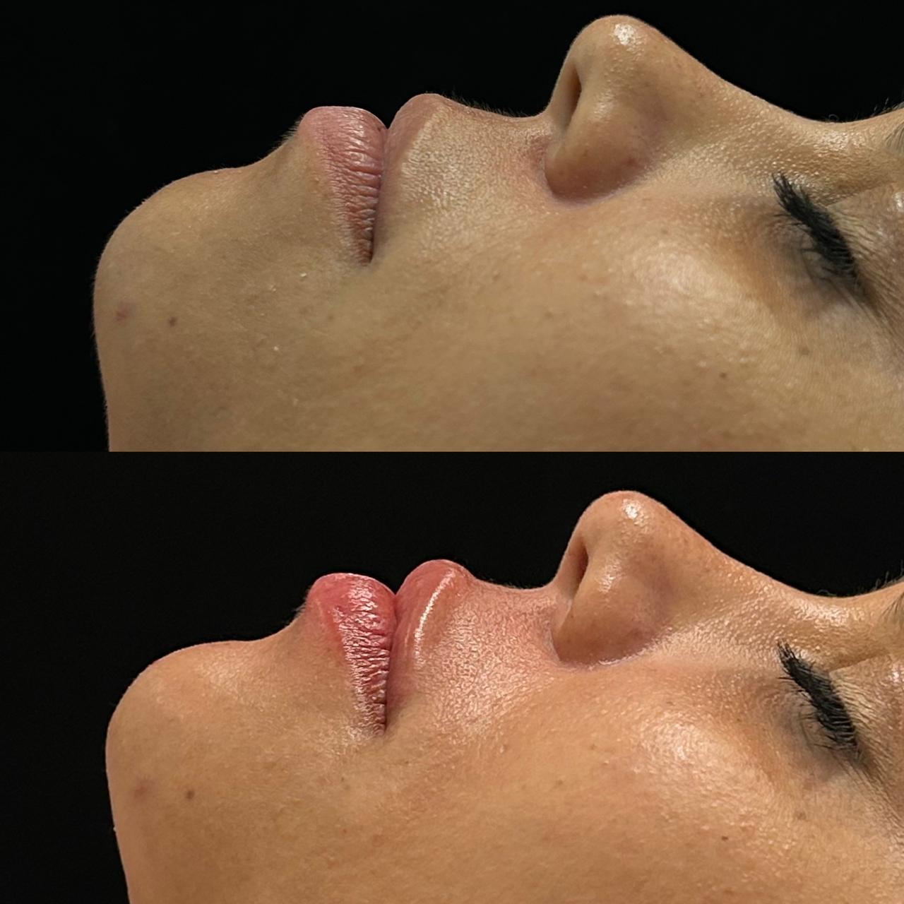 Antes e depois — Lábios & sulcos