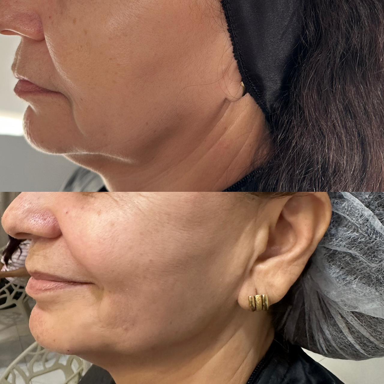 Antes e depois — Papada & linha mandibular