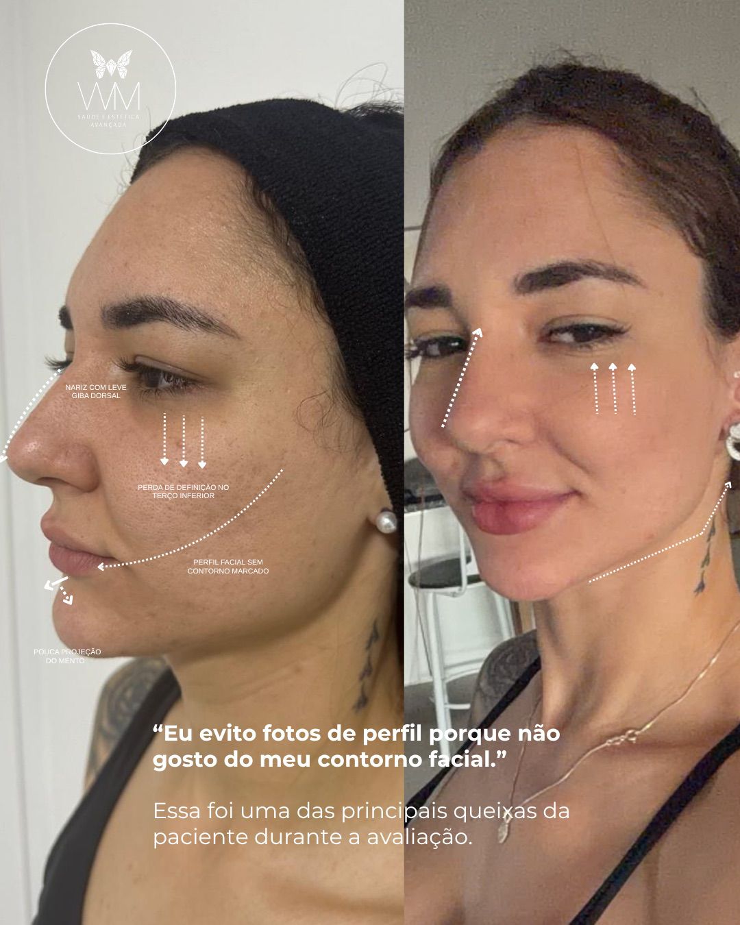 Antes e depois — Harmonização completa de perfil