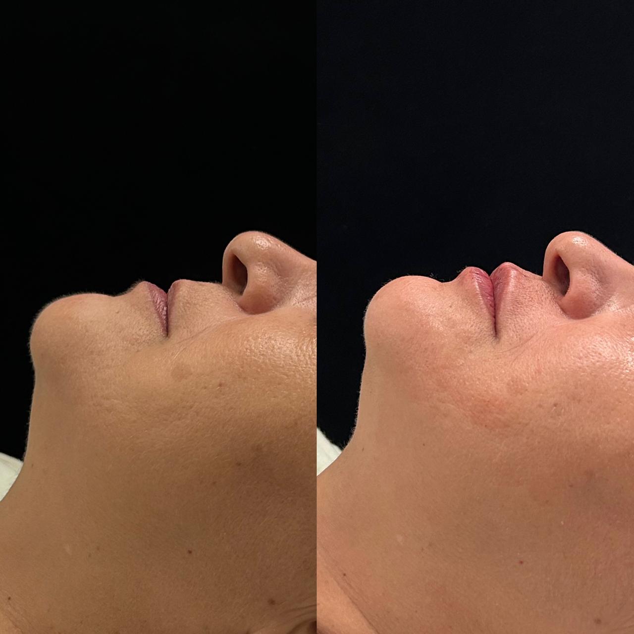 Antes e depois — Mento & bigode chinês