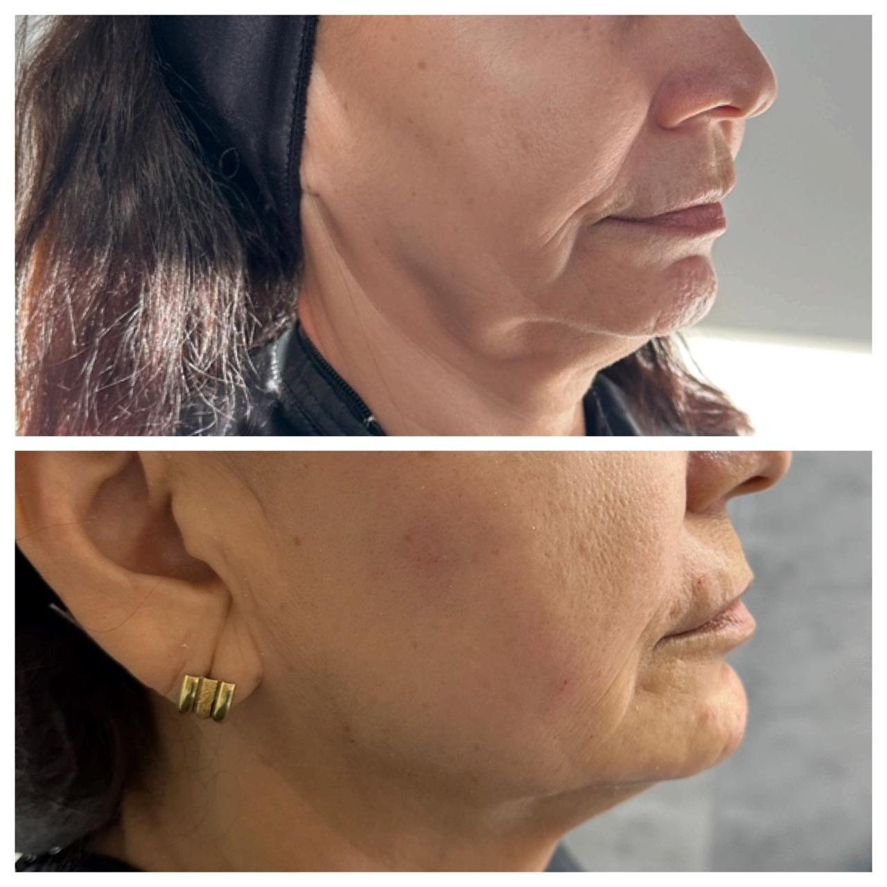 Antes e depois — Rejuvenescimento do terço inferior
