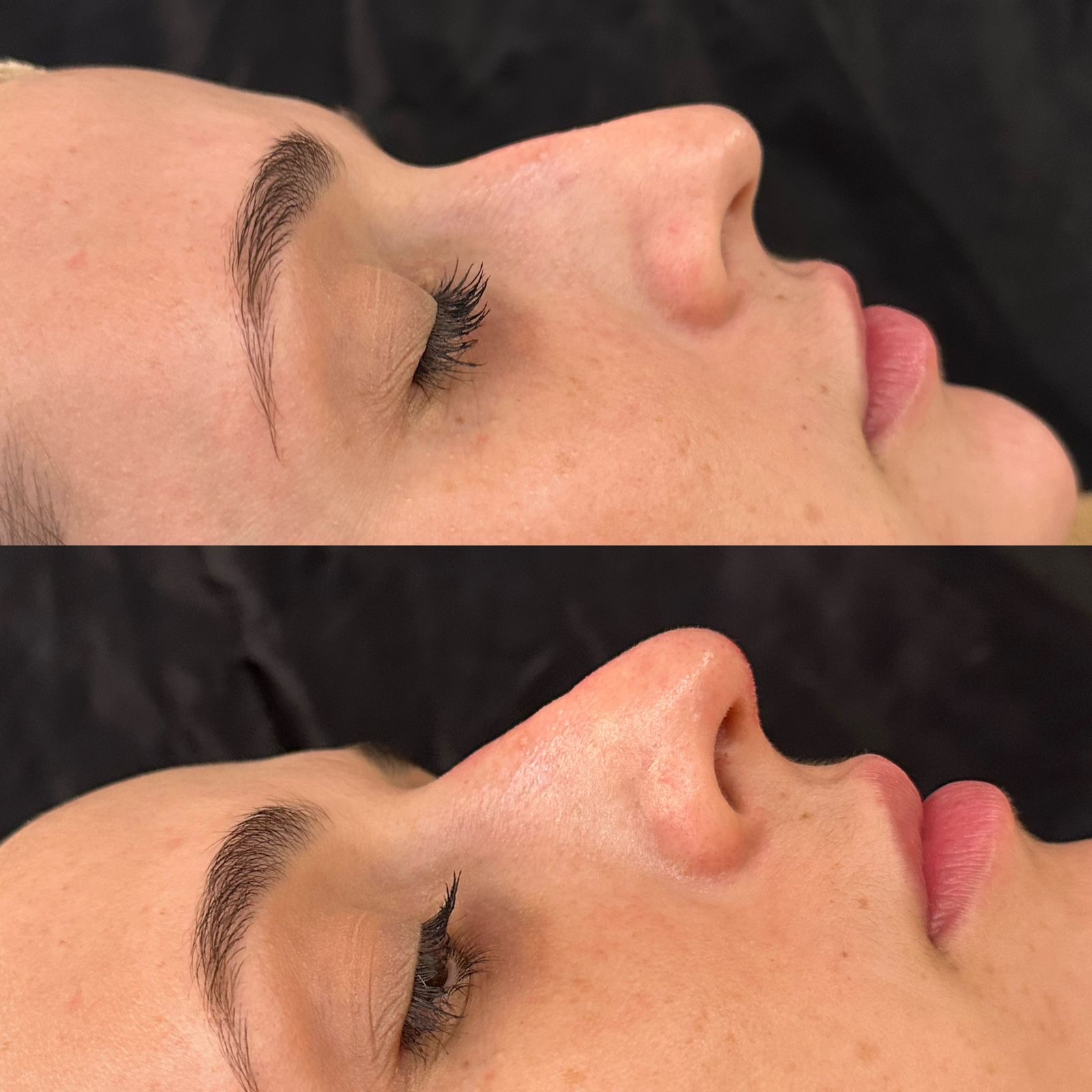 Antes e depois — Perfil nasal refinado