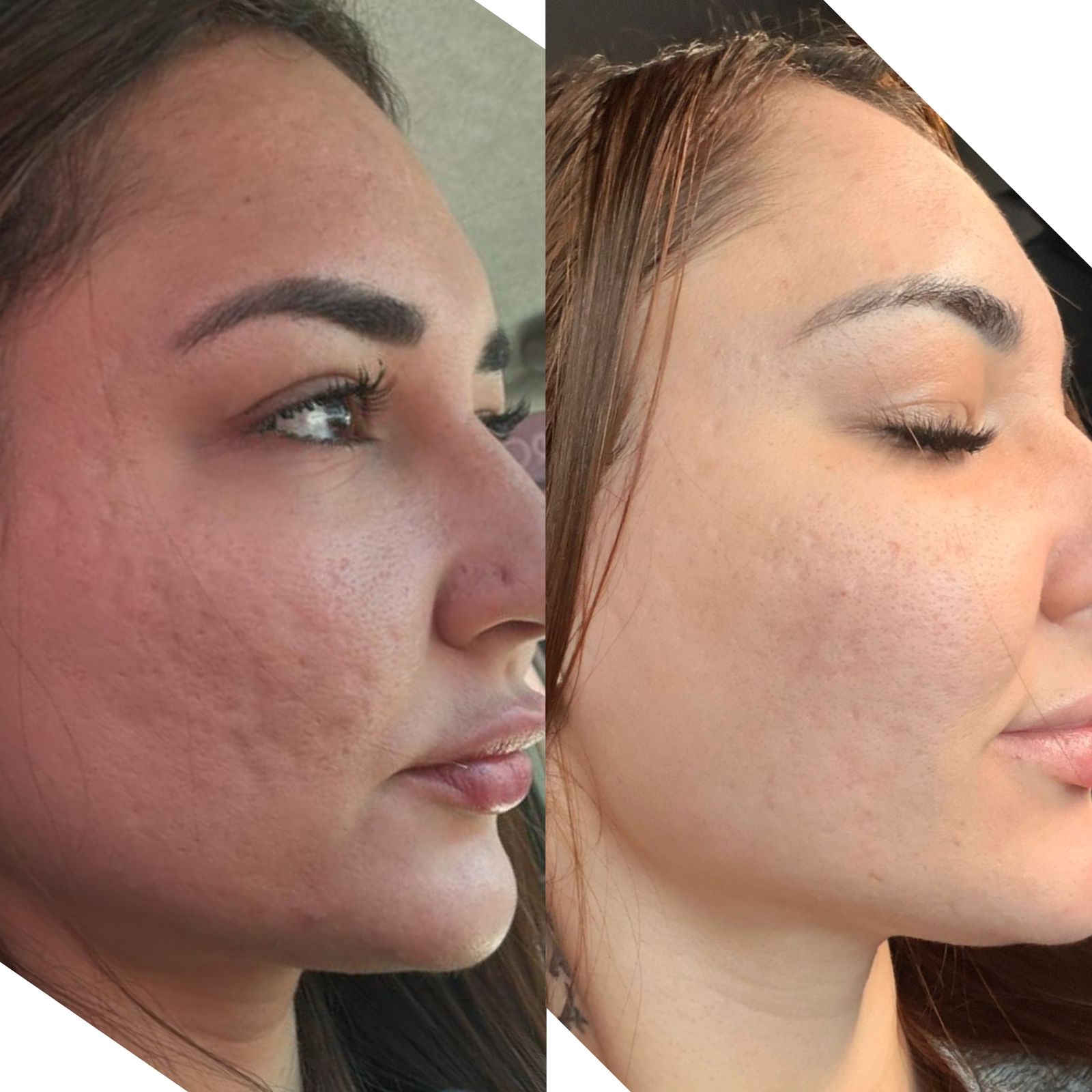 Antes e depois — Textura & cicatrizes de acne