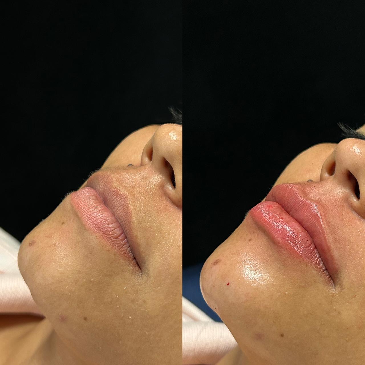 Antes e depois — Preenchimento labial