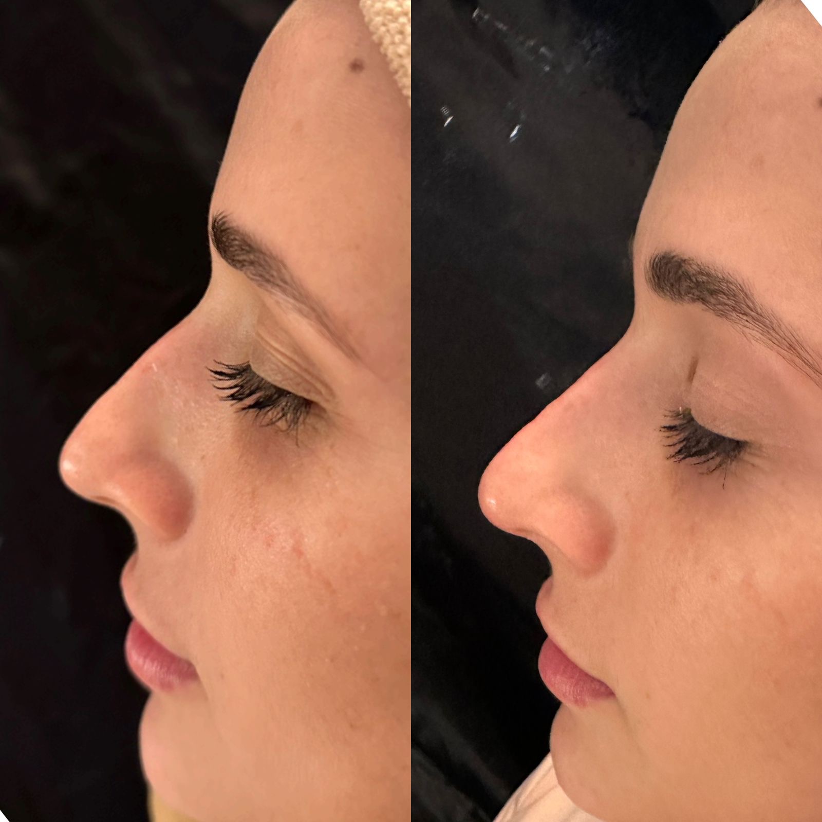Antes e depois — Rinomodelação