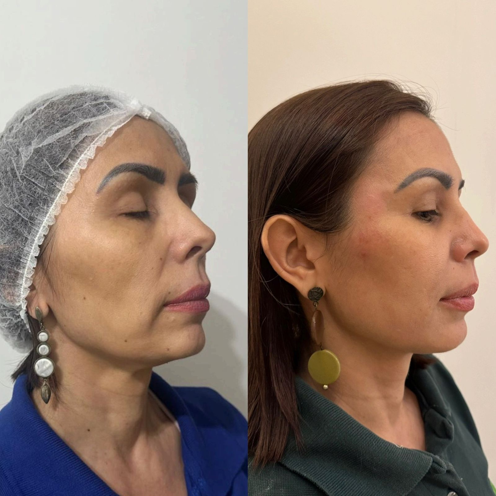 Antes e depois — Contorno & sustentação