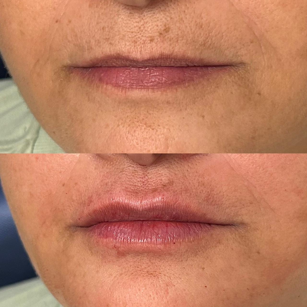 Antes e depois — Código de barras & contorno